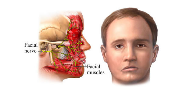 Drooping Face: How to Treat Bell's Palsy with Physiotherapy - pt